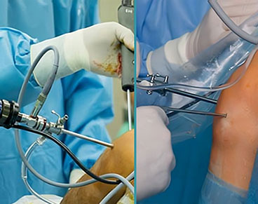 Arthroscopy